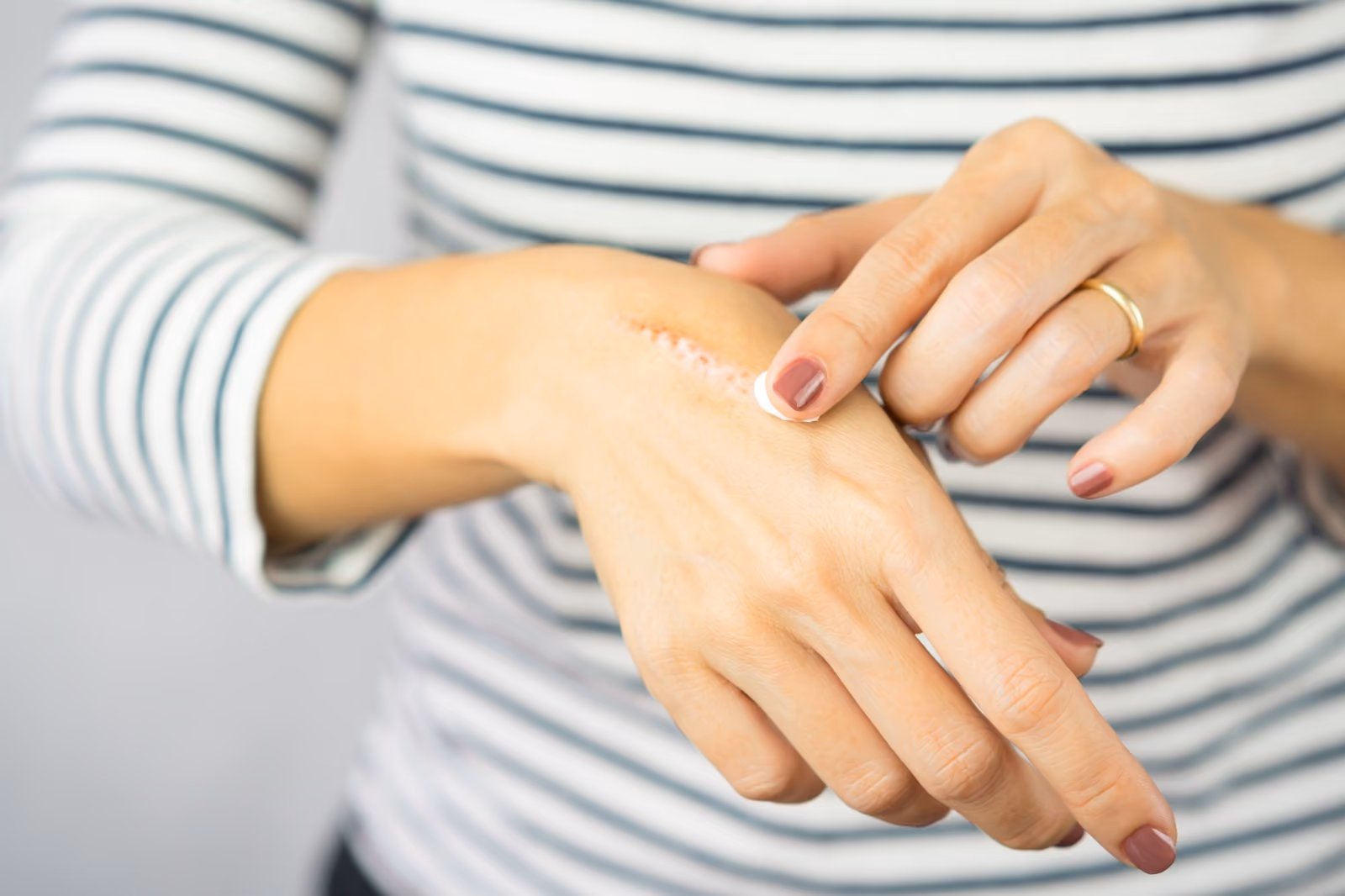 Femme appliquant une crème cicatrisante sur une cicatrice de brûlure à la main